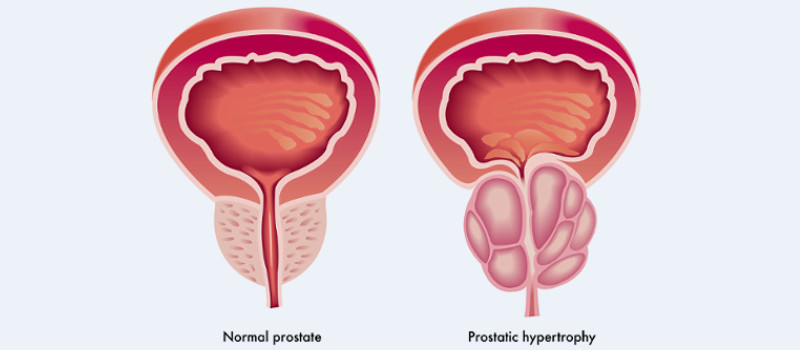 kidney stone disease 1